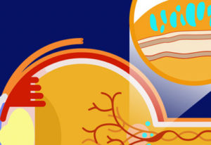 close up illustration of an eye with DME